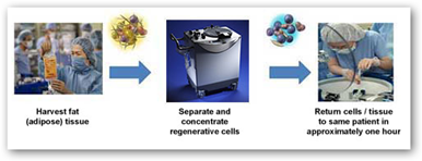 Cytori Therapeutics Receives Notice From FDA that The Celution 700 ...